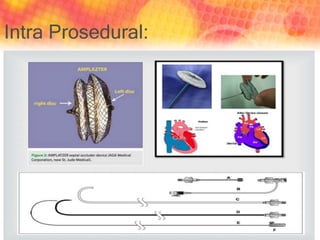 Intra Prosedural:
 