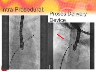 Intra Prosedural:
Proses Delivery
Device
 