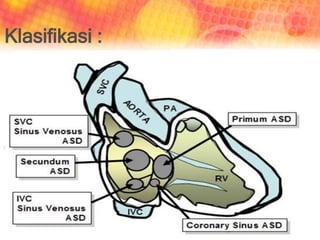 Jenis ASD
dibedakan menjadi
3, yaitu:
1. ASD Sinus
Venosus
2. ASD Ostium
Sekundum
3. ASD Ostium
Primum
(Sommer RJ, 2008)
Klasifikasi :
 