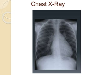Chest X-Ray
 