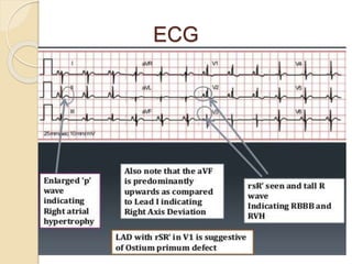 ECG
 