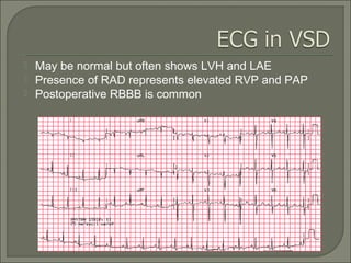  May be normal but often shows LVH and LAE
 Presence of RAD represents elevated RVP and PAP
 Postoperative RBBB is common
 