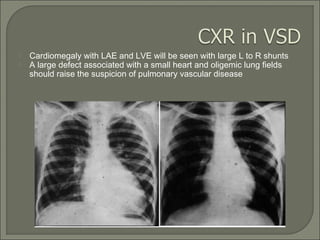  Cardiomegaly with LAE and LVE will be seen with large L to R shunts
 A large defect associated with a small heart and oligemic lung fields
should raise the suspicion of pulmonary vascular disease
 