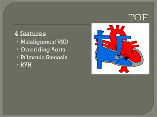  4 features
• Malalignment VSD
• Overriding Aorta
• Pulmonic Stenosis
• RVH
 