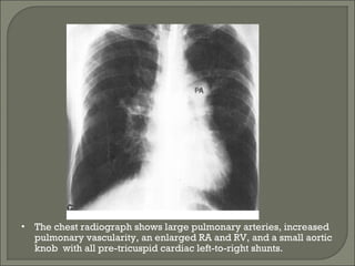 • The chest radiograph shows large pulmonary arteries, increased
pulmonary vascularity, an enlarged RA and RV, and a small aortic
knob with all pre-tricuspid cardiac left-to-right shunts.
 