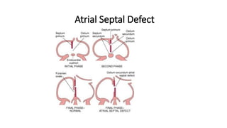 ASD AND VSD (1).pptx ATRIAL SEPTAL DEFECT AND VENTRICULAR SEPTAL DEFECT ...