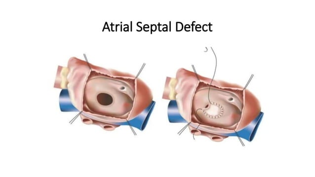 ASD AND VSD (1).pptx ATRIAL SEPTAL DEFECT AND VENTRICULAR SEPTAL DEFECT ...