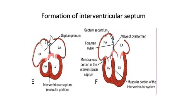 ASD AND VSD (1).pptx ATRIAL SEPTAL DEFECT AND VENTRICULAR SEPTAL DEFECT ...