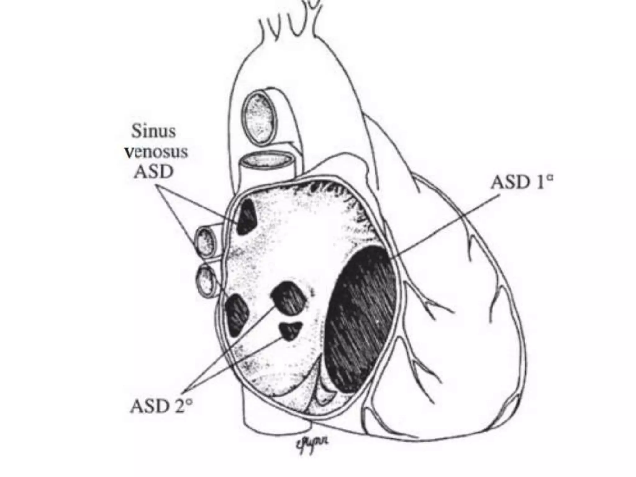 Asd echo assessment | PPTX