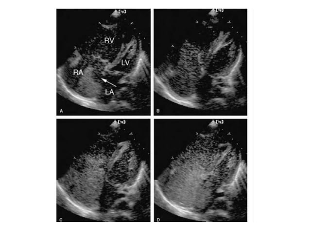 Asd echo assessment | PPTX