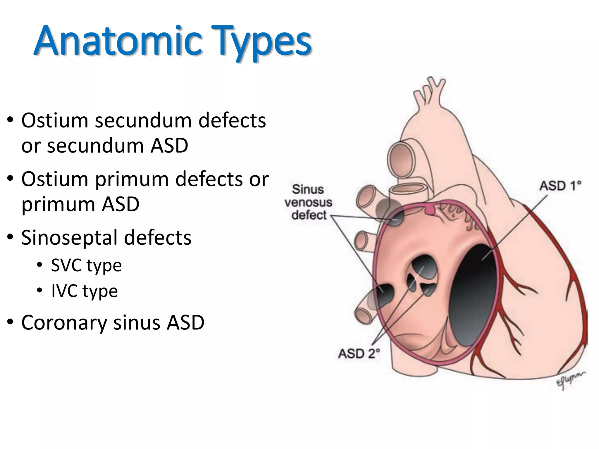Atrial Septal Defect | PPTX