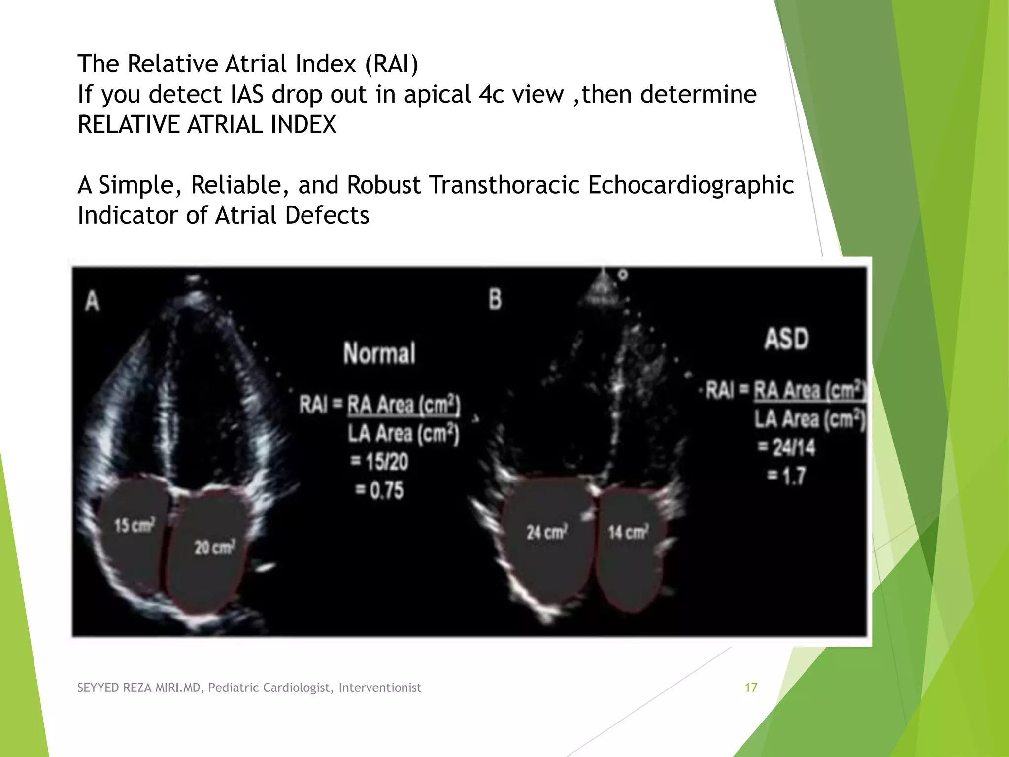 SEYYED REZA MIRI.MD, Pediatric Cardiologist, Interventionist 17
The Relative Atrial Index (RAI)
If you detect IAS drop out in apical 4c view ,then determine
RELATIVE ATRIAL INDEX
A Simple, Reliable, and Robust Transthoracic Echocardiographic
Indicator of Atrial Defects
 