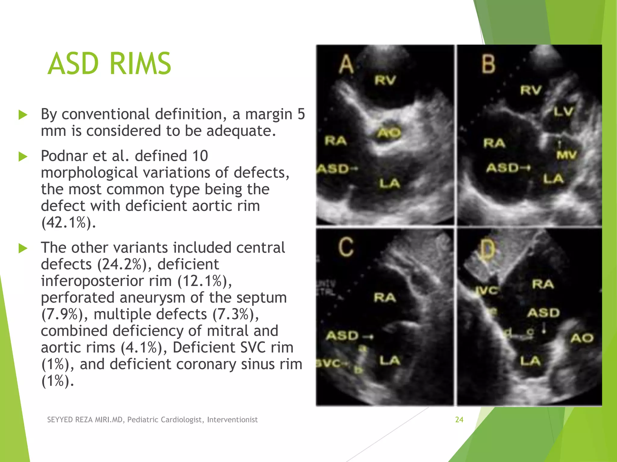 ASD RIMS
 By conventional definition, a margin 5
mm is considered to be adequate.
 Podnar et al. defined 10
morphological variations of defects,
the most common type being the
defect with deficient aortic rim
(42.1%).
 The other variants included central
defects (24.2%), deficient
inferoposterior rim (12.1%),
perforated aneurysm of the septum
(7.9%), multiple defects (7.3%),
combined deficiency of mitral and
aortic rims (4.1%), Deficient SVC rim
(1%), and deficient coronary sinus rim
(1%).
SEYYED REZA MIRI.MD, Pediatric Cardiologist, Interventionist 24
 