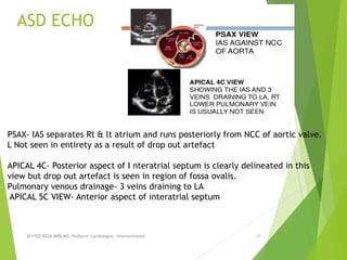ASD ECHO
SEYYED REZA MIRI.MD, Pediatric Cardiologist, Interventionist 15
PSAX- IAS separates Rt & lt atrium and runs posteriorly from NCC of aortic valve.
L Not seen in entirety as a result of drop out artefact
APICAL 4C- Posterior aspect of I nteratrial septum is clearly delineated in this
view but drop out artefact is seen in region of fossa ovalis.
Pulmonary venous drainage- 3 veins draining to LA
APICAL 5C VIEW- Anterior aspect of interatrial septum
 