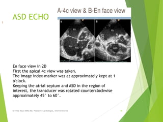 ASD ECHO
SEYYED REZA MIRI.MD, Pediatric Cardiologist, Interventionist 18
I
En face view in 2D
First the apical 4c view was taken.
The image index marker was at approximately kept at 1
o'clock.
Keeping the atrial septum and ASD in the region of
interest, the transducer was rotated counterclockwise
approximately 45° to 60°.
 