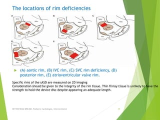 The locations of rim deficiencies
 (A) aortic rim, (B) IVC rim, (C) SVC rim deficiency, (D)
posterior rim, (E) atrioventricular valve rim.
SEYYED REZA MIRI.MD, Pediatric Cardiologist, Interventionist 25
Specific rims of the sASD are measured on 2D imaging
Consideration should be given to the integrity of the rim tissue. Thin flimsy tissue is unlikely to have the
strength to hold the device disc despite appearing an adequate length.
 