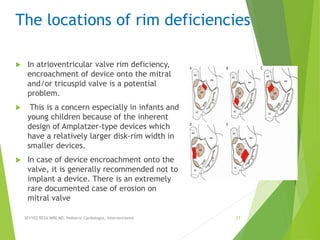 The locations of rim deficiencies
 In atrioventricular valve rim deficiency,
encroachment of device onto the mitral
and/or tricuspid valve is a potential
problem.
 This is a concern especially in infants and
young children because of the inherent
design of Amplatzer-type devices which
have a relatively larger disk-rim width in
smaller devices.
 In case of device encroachment onto the
valve, it is generally recommended not to
implant a device. There is an extremely
rare documented case of erosion on
mitral valve
SEYYED REZA MIRI.MD, Pediatric Cardiologist, Interventionist 27
 