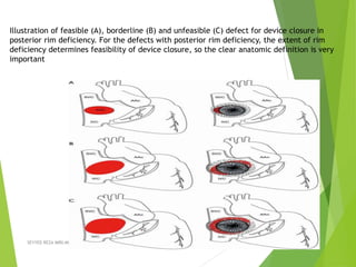 Illustration of feasible (A), borderline (B) and unfeasible (C) defect for device closure in
posterior rim deficiency. For the defects with posterior rim deficiency, the extent of rim
deficiency determines feasibility of device closure, so the clear anatomic definition is very
important
SEYYED REZA MIRI.MD, Pediatric Cardiologist, Interventionist 36
 