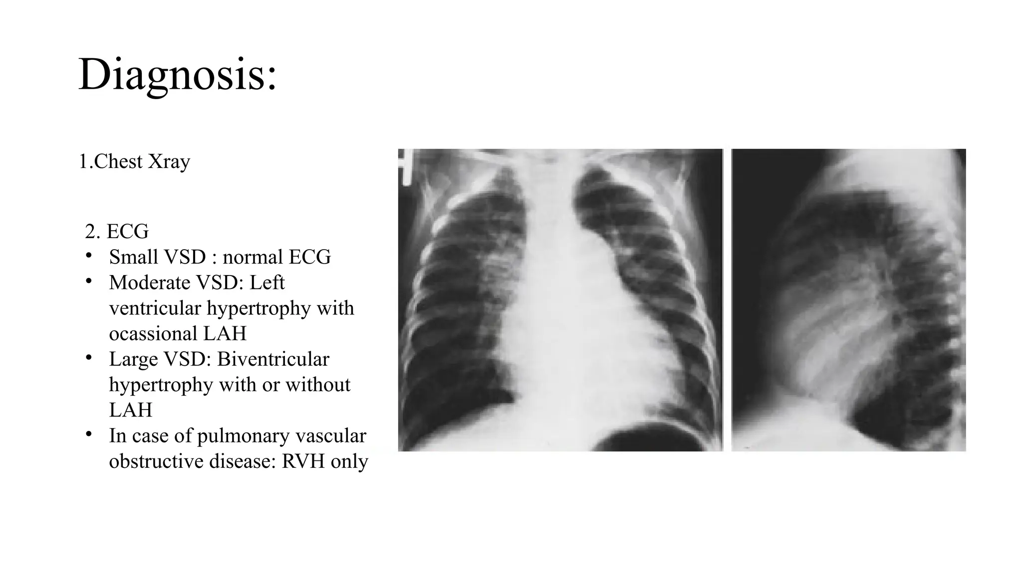 Diagnosis:
1.Chest Xray
2. ECG
• Small VSD : normal ECG
• Moderate VSD: Left
ventricular hypertrophy with
ocassional LAH
• Large VSD: Biventricular
hypertrophy with or without
LAH
• In case of pulmonary vascular
obstructive disease: RVH only
 