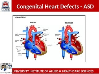 Comprehensive Overview of Congenital Heart Defects: ASD and VSD | PPTX