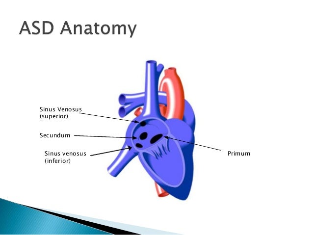 ASD ,VSD elkhatib
Sinus Venosus Asd