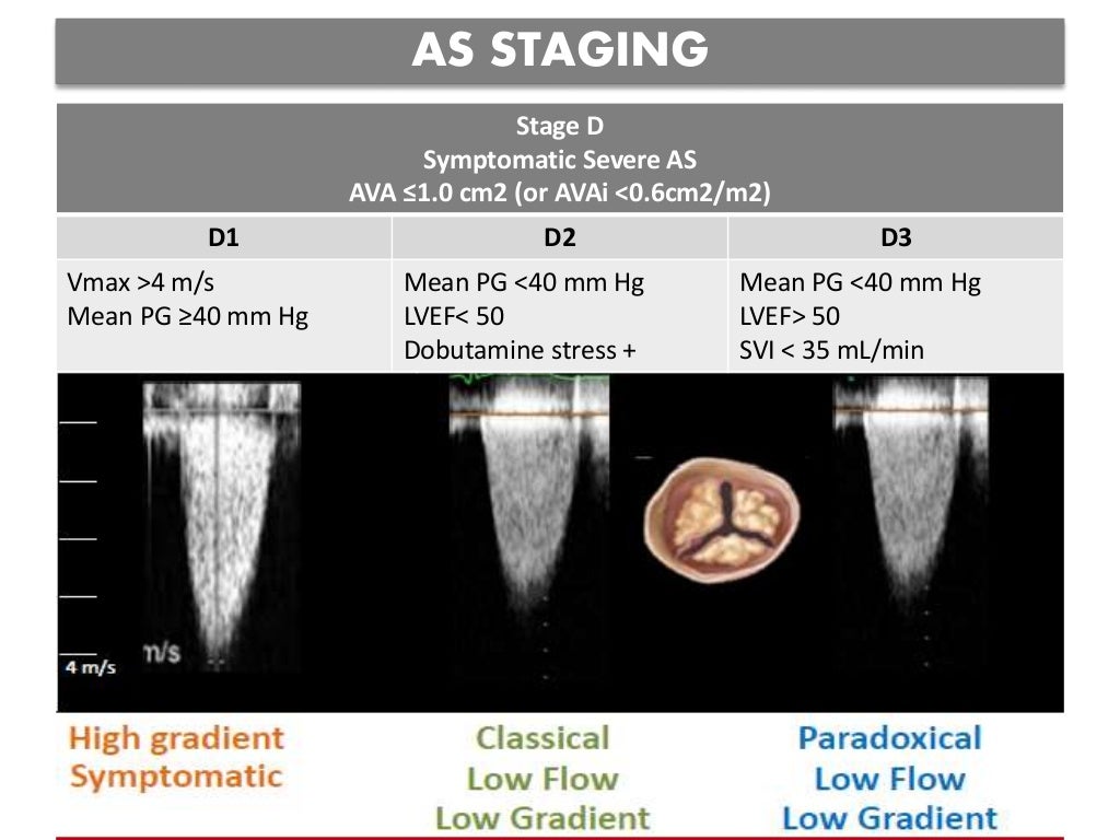 echocardiographic-evaluation-of-aortic-stenosis