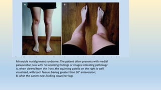 Pf Malalignment Knee joint assessment | PPTX