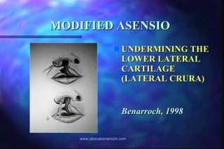 MODIFIED ASENSIO   UNDERMINING THE LOWER LATERAL CARTILAGE (LATERAL CRURA) Benarroch, 1998 