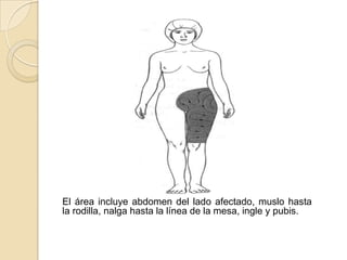 Codo y antebrazoSe coloca una talla debajo del hombro y la axila.El brazo se sujeta cogiéndolo por la mano.El área incluye la totalidad del brazo desde el hombro y la axila y la mano.