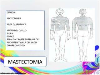 MASTECTOMIA
CIRUGIA
MATECTOMIA
AREA QUIRURGICA
MITAD DEL CUELLO
NUCA
TORAX
ESPALDA Y PARTE SUPERIOR DEL
ABDOMEN Y AXILA DEL LADO
COMPROMETIDO
 