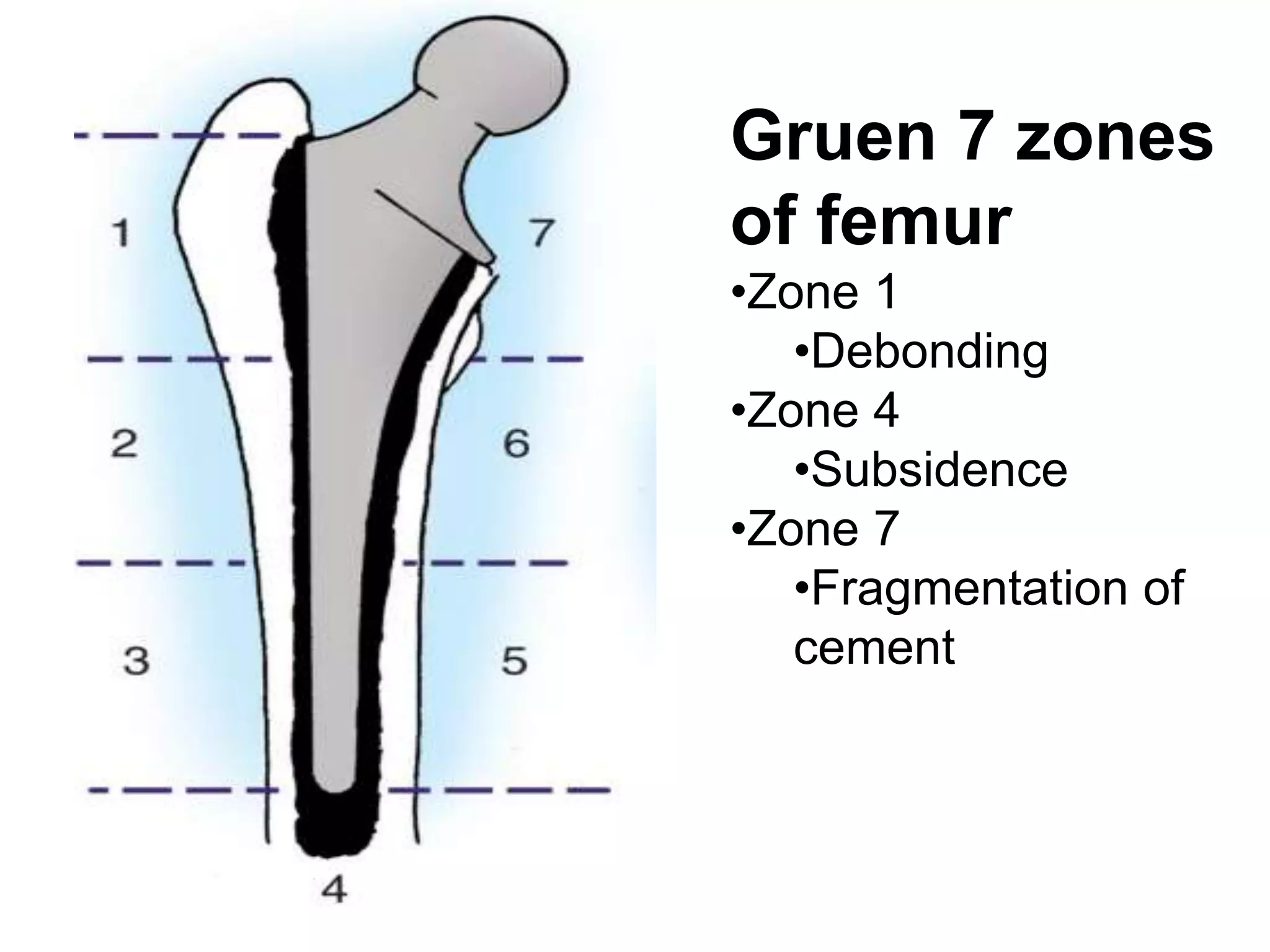 Aseptic loosening total hip arthroplasty | PPTX