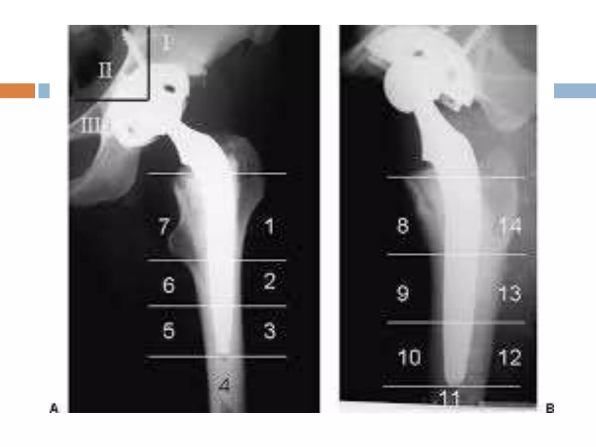 Aseptic loosening total hip arthroplasty | PPTX