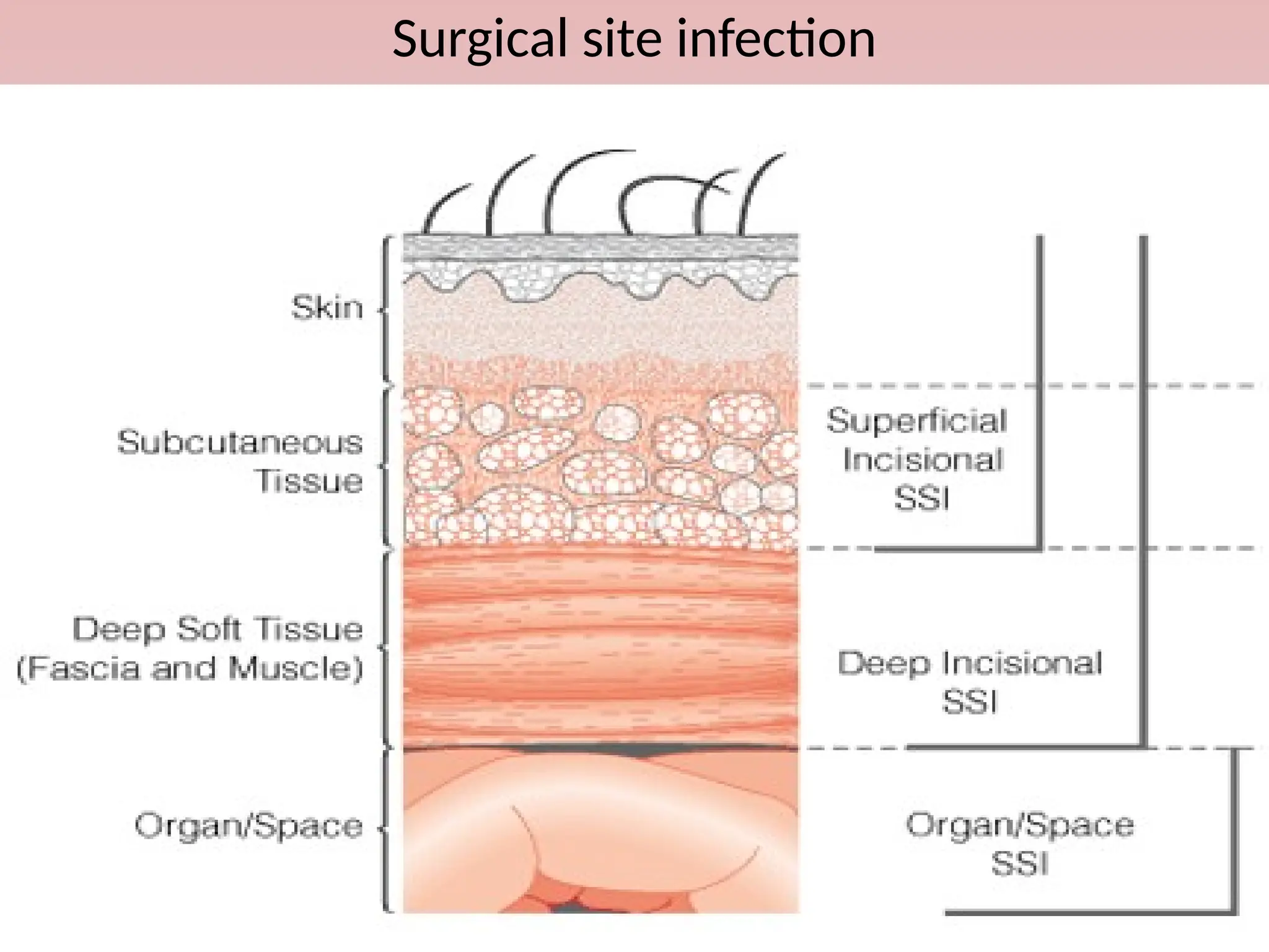 Surgical site infection
 