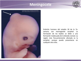 Meningocele
Embrión humano del estadio 18 de la 7a.
semana con meningocele occipital. La
herniación de los tejidos se debe a una
formación inadecuada de la bóveda craneal. La
región más frecuentemente afectada es la
occipital, aunque puede presentarse en
cualquier otro sitio.
 