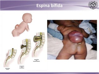 Espina bífida
 