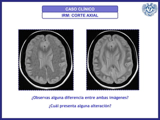 IRM: CORTE AXIAL
CASO CLÍNICO
¿Observas alguna diferencia entre ambas imágenes?
¿Cuál presenta alguna alteración?
 