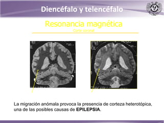 Resonancia magnética
Corte coronal
Normal
La migración anómala provoca la presencia de corteza heterotópica,
una de las posibles causas de EPILEPSIA.
Diencéfalo y telencéfalo
 