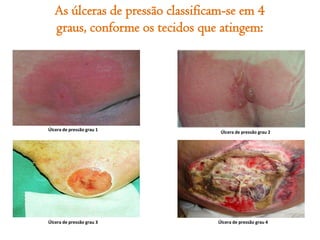 As úlceras de pressão classificam-se em 4
graus, conforme os tecidos que atingem:

Úlcera de pressão grau 1

Úlcera de pressão grau 3

Úlcera de pressão grau 2

Úlcera de pressão grau 4

 