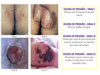 Eritema não branqueável em pele
intacta

Flictena (bolhas de água)

Destruição total da pele envolvendo
necrose (tecido preto ou amarelo)
do tecido subcutâneo

Destruição extensa, necrose dos
tecidos (tecido preto) ou lesão
muscular, óssea

 