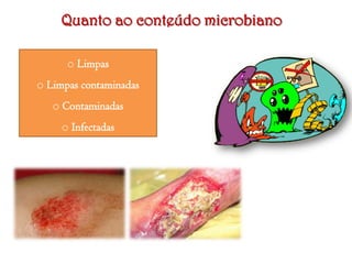 Quanto ao conteúdo microbiano
o Limpas
o Limpas contaminadas
o Contaminadas
o Infectadas

 