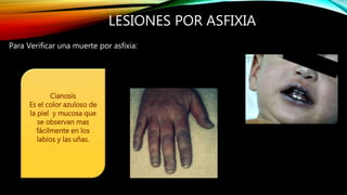 LESIONES POR ASFIXIA
Para Verificar una muerte por asfixia:
Cianosis
Es el color azuloso de
la piel y mucosa que
se observan mas
fácilmente en los
labios y las uñas.
 