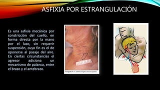 ASFIXIA POR ESTRANGULACIÓN
 