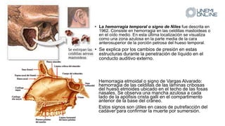 • La hemorragia temporal o signo de Niles fue descrita en
1962. Consiste en hemorragia en las celdillas mastoideas o
en el oído medio. En esta última localización se visualiza
como una zona azulosa en la parte media de la cara
anterosuperior de la porción petrosa del hueso temporal.
• Se explica por los cambios de presión en estas
estructuras durante la penetración de líquido en el
conducto auditivo externo.
• Hemorragia etmoidal o signo de Vargas Alvarado:
hemorragia de las celdillas de las láminas cribosas
del hueso etmoides ubicado en el techo de las fosas
nasales. Se observa una mancha azulosa a cada
lado de la apófisis crista galli en el compartimento
anterior de la base del cráneo.
• Estos signos son útiles en casos de putrefacción del
cadáver para confirmar la muerte por sumersión.
 