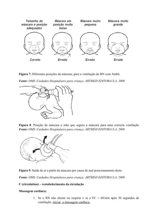Figura 7. Diferentes posições da máscara, para a ventilação do RN com Ambú
Fonte: OMS. Cuidados Hospitalares para criança. ARTMED EDITORA S.A. 2008
Figura 8. Posição da máscara e mão que segura a máscara para uma correcta ventilação
Fonte: OMS. Cuidados Hospitalares para criança. ARTMED EDITORA S.A. 2008
Figura 9. Saída de ar a partir da máscara por causa de mal posicionamento desta
Fonte: OMS. Cuidados Hospitalares para criança. ARTMED EDITORA S.A. 2008
C (circulation) – restabelecimento da circulação
Massagem cardíaca:
1. Se o RN não chorar ou respirar e se a FC < 60/min após 30 segundos de
ventilação, iniciar a massagem cardíaca;
 