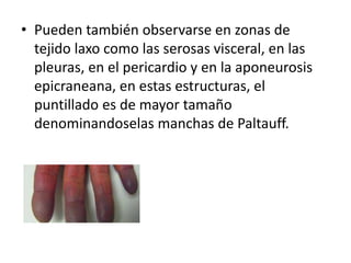 • Pueden también observarse en zonas de
tejido laxo como las serosas visceral, en las
pleuras, en el pericardio y en la aponeurosis
epicraneana, en estas estructuras, el
puntillado es de mayor tamaño
denominandoselas manchas de Paltauff.
 