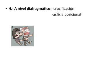 • 4.- A nivel diafragmático: -crucificación
-asfixia posicional
 