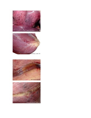 Asfixias+ esquema---