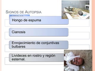 SIGNOS DE AUTOPSIA
EXTERNOS
Hongo de espuma
Cianosis
Enrojecimiento de conjuntivas
bulbares
Livideces en rostro y región
esternal.
 