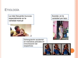 ETIOLOGÍA
La más frecuente Homicida:
especialmente en la
variedad manual
Suicida: en la
variedad por lazo
Estrangulación accidental:
en maniobras policiales en
inmovilización del
sospechoso
 