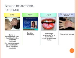 SIGNOS DE AUTOPSIA.
EXTERNOS
Surco de
estrangulación: bajo
el cartílago tiroides.
*completo
*horizontal
Por mano: equimosis
por presión de los
dedos o estigmas
ungueales
cuello
Cianótico y
tumefacto
Rostro
Hemorragia
antemortem en el
corion al ser
proyectada entre los
dientes
Lengua
Contusiones simples
En el dorso de las
manos
 